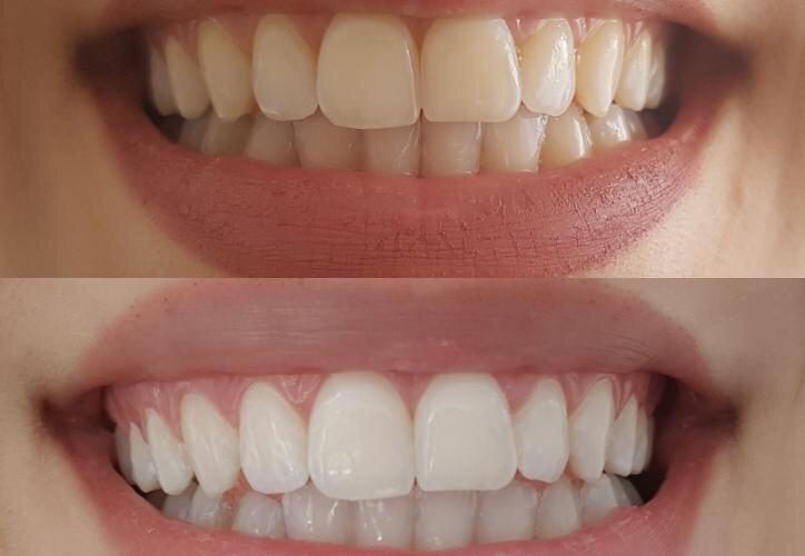 Lila Whitening Tandpulver